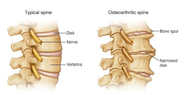 bone-spurs=on-spine-enlarge-image-one-point-blogs